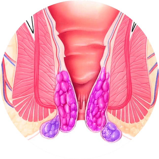 Gelarex lindert die Symptome bereits bei der ersten Anwendung